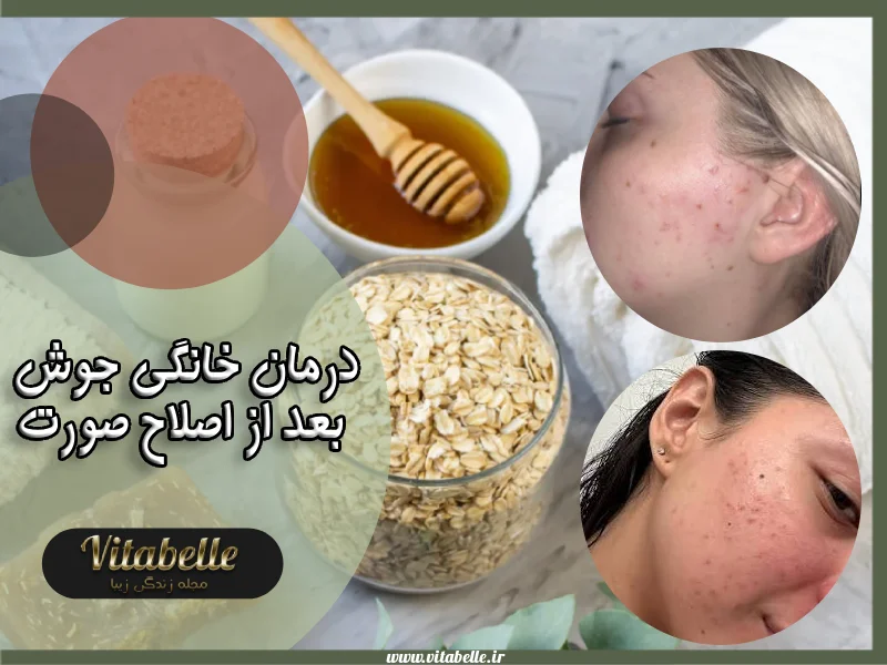 درمان خانگی جوش بعد از اصلاح صورت | روش های سریع و ساده